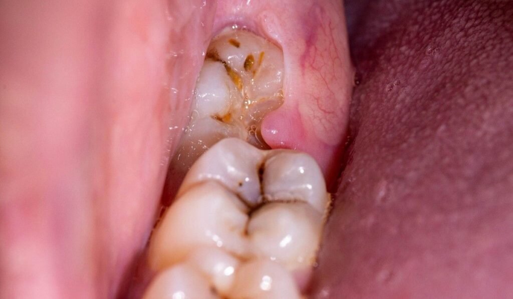 Impacted Teeth Removal in Adambakkam