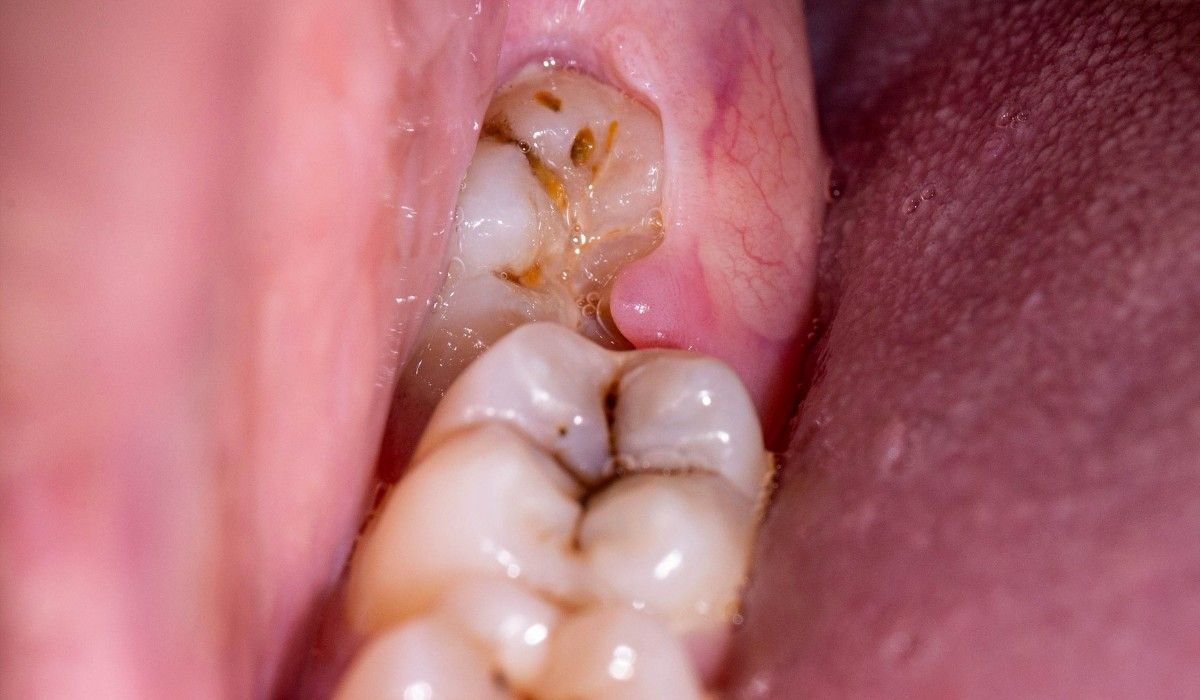 Impacted Teeth Removal in Adambakkam