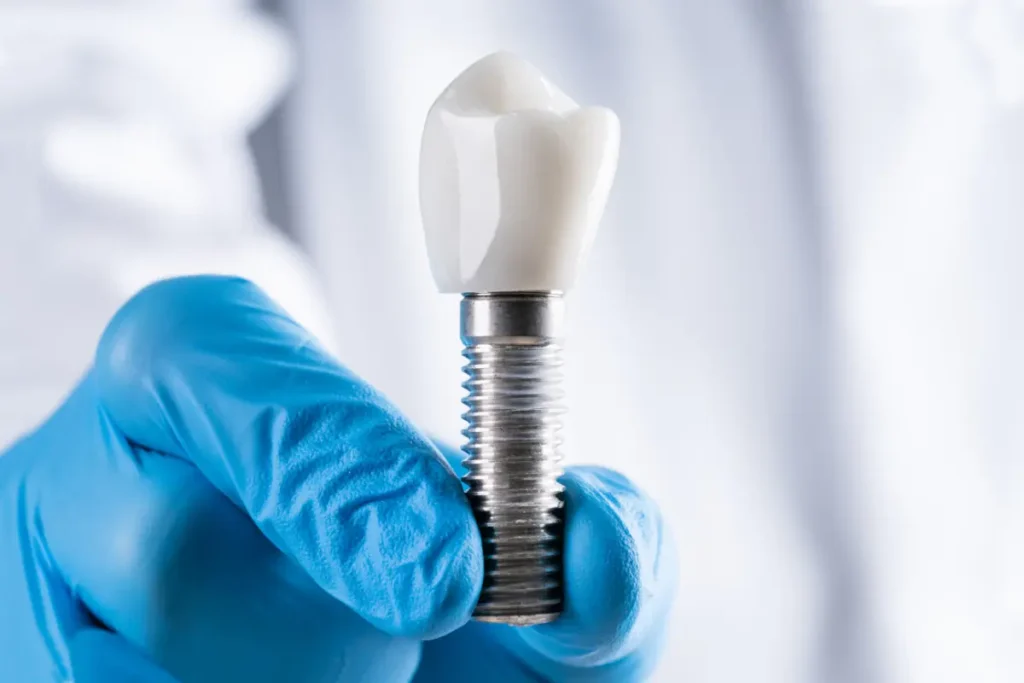 Dental Implants in Chennai