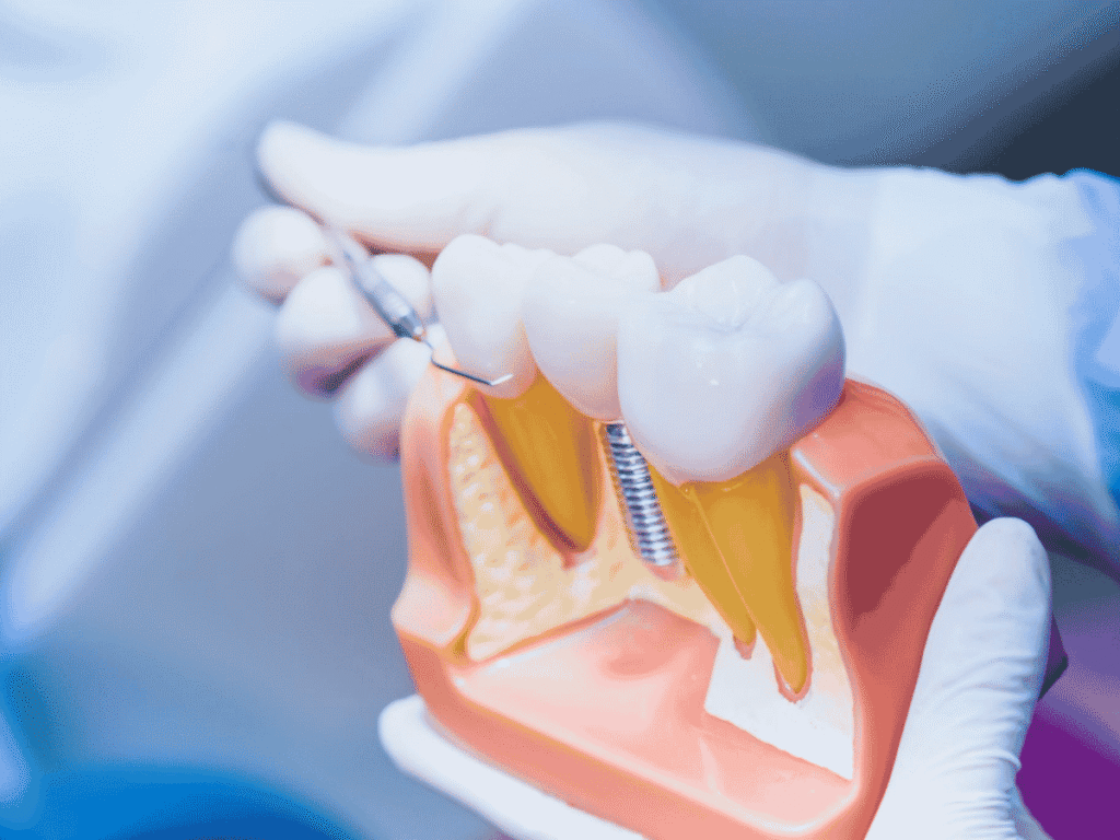 Dental implants