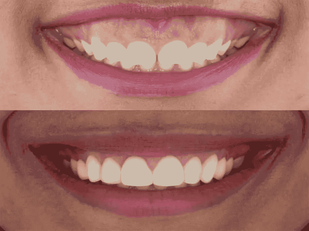 Smile Makeover in Adambakkam