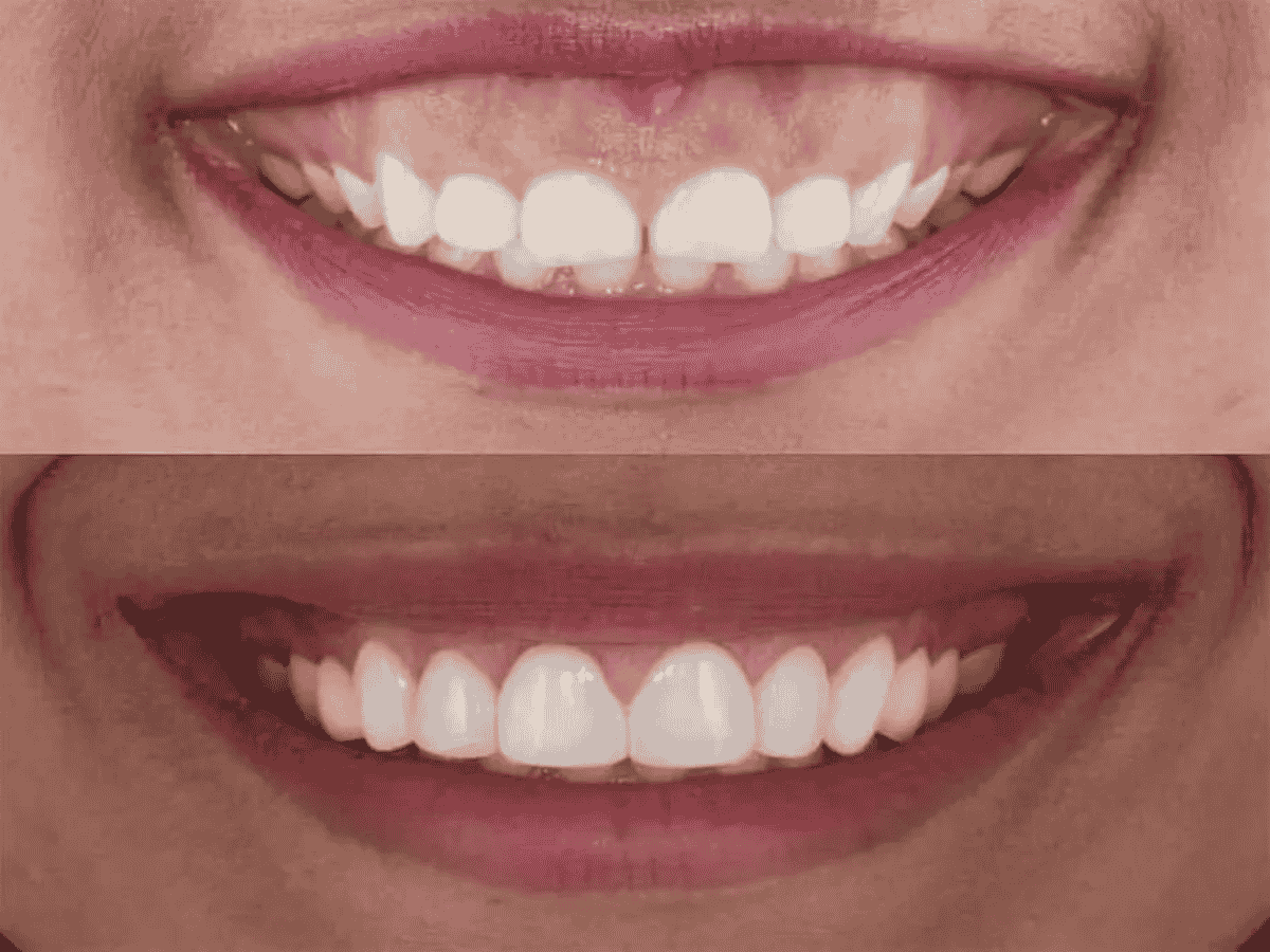 Smile Makeover in Adambakkam