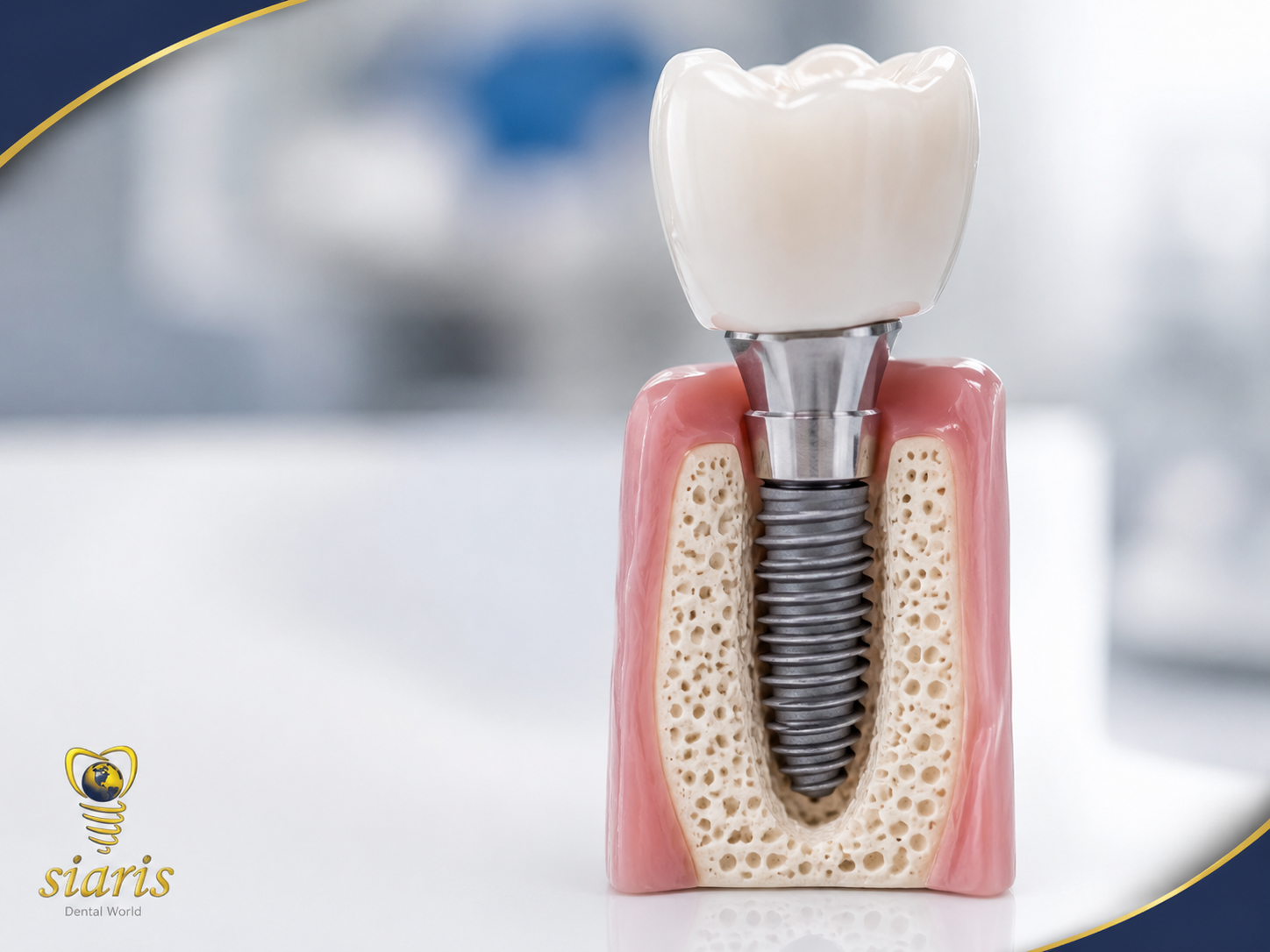 Single Tooth Implant in Adambakkam